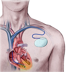 Arrhythmia - York Cardiology